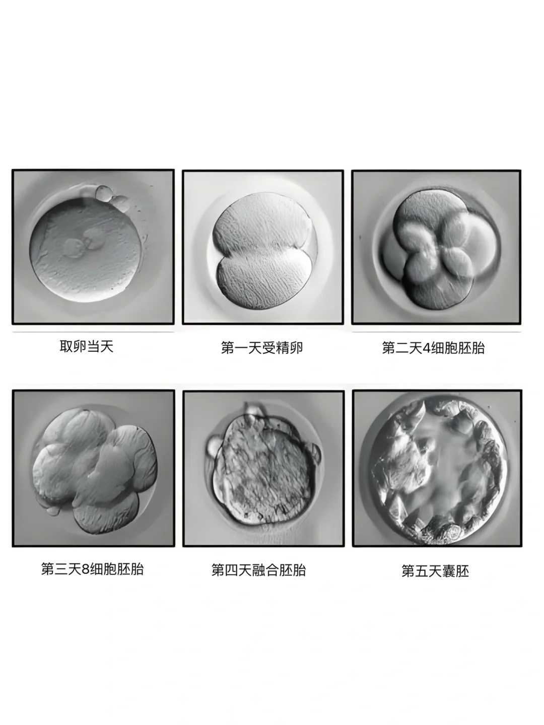 多囊卵巢做试管怎么样